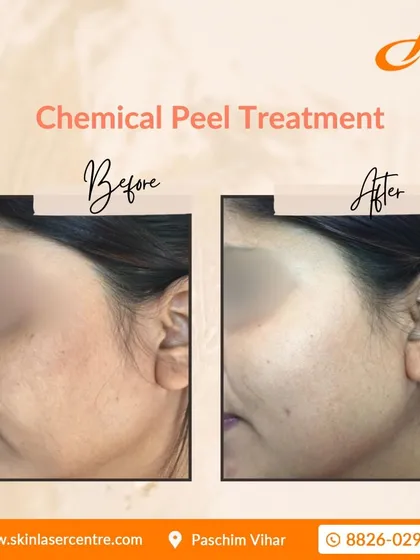 This before and after image shows the effectiveness of a personalized chemical peel plan. Notice the significant improvement in skin texture, reduced pigmentation, and overall clarity. My goal is to achieve a healthy, even-toned complexion for you.