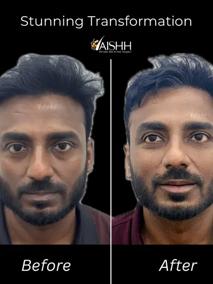This is a great example of a full-face rejuvenation. We addressed concerns like a tired look from under-eye bags, flat cheeks, and thin lips using a few milliliters of hyaluronic acid filler to restore volume and structure for a refreshed, confident appearance.