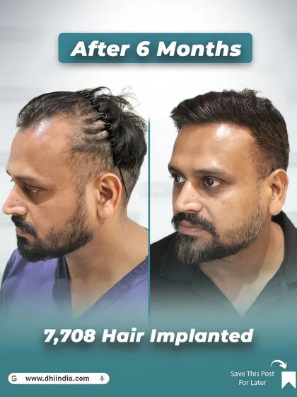 This alternate side-profile view of Gaurav's 6-month transformation showcases the comprehensive coverage and natural flow of his new hair. Our DHI technique ensures every angle looks perfect.