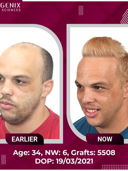 The full head hair transplant results for an international patient, showcasing a complete change with 5508 grafts.