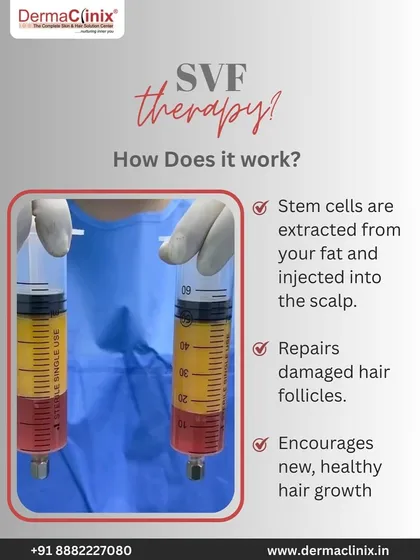 How does SVF therapy work? We extract stem cells from your own fat and inject them into the scalp to repair damaged follicles and encourage new, healthy hair growth.