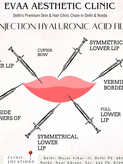This diagram illustrates the precise injection points for hyaluronic acid lip fillers. We target specific areas like the cupid's bow and vermillion border to achieve a symmetrical and beautifully shaped result.
