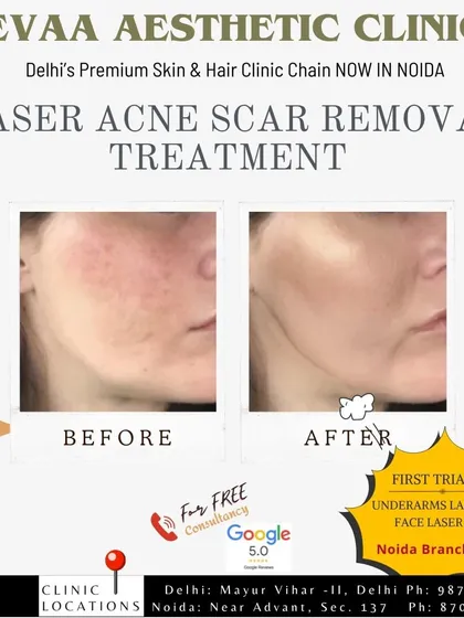 See the results of our laser acne scar removal treatment. This post also features a trial offer for underarm and face laser treatments at our Noida branch.