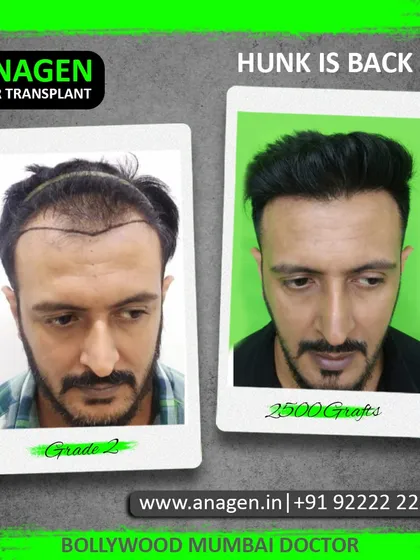 "Hunk is back." A 2500 graft transplant was all it took to restore this patient's Grade 2 hair loss and bring back his handsome, youthful appearance.