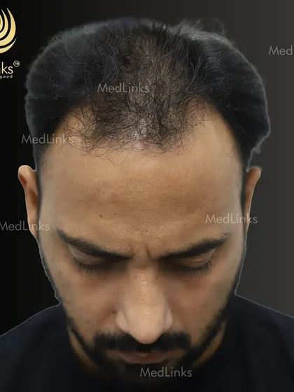 A top-down view of the patient's hair loss before the transplant.