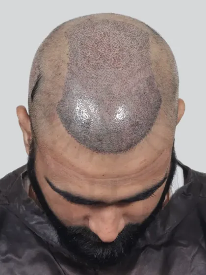 This is what a scalp looks like immediately after the procedure. Each dot is a carefully placed graft, the foundation of a future full head of hair.