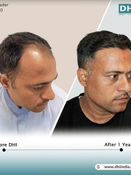 A side-profile before and after of the same client one year post-transplant. The restored hairline and natural density have completely transformed his appearance and confidence.