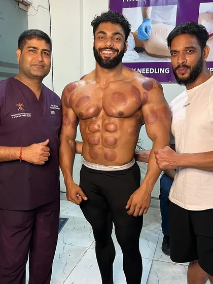 This photo with IFBB Pro Rahul Fitness and another athlete shows the immediate after-effects of a cupping session. The marks indicate areas of high muscle tension and stagnation, which we successfully addressed to improve blood flow and recovery.
