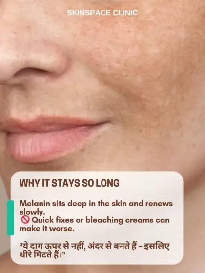 Pigmentation stays so long because the melanin sits deep within the skin. Quick fixes or harsh bleaching creams can often make the problem worse, which is why a patient, professional approach is necessary.