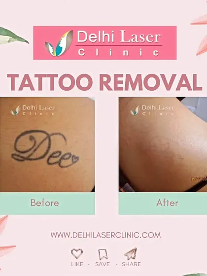 Here is a clear before and after from a laser tattoo removal treatment. We used our US FDA-approved Medlite C6 Q-Switch laser to break down the ink particles over several sessions, resulting in the tattoo fading completely and leaving clear skin.