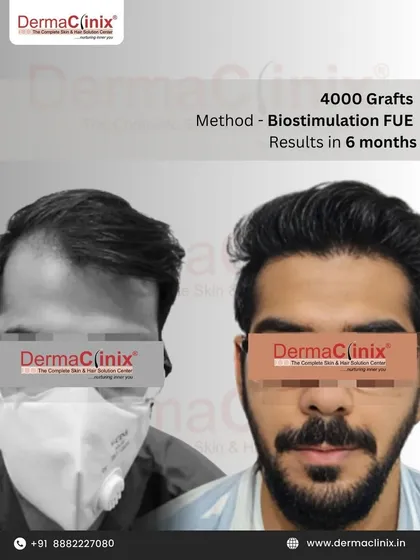 This is a clear example of what's possible with our Biostimulation FUE method. This patient received 4000 grafts, and this is the significant regrowth and density achieved in just six months.