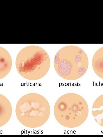 This graphic shows several common skin conditions I treat in children, including eczema, psoriasis, acne, and vitiligo. Early and accurate diagnosis by a dermatologist is key to effective management and preventing long-term issues.