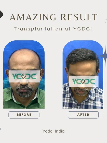 This result shows my strategic approach to advanced, Grade 6 baldness. Instead of thinning out the grafts over a large area, I focused on creating high density in the frontal zone for the most significant cosmetic improvement in a single session.