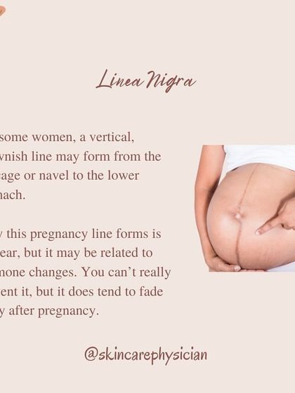 The "pregnancy line," or linea nigra, is a classic example of hormone-induced skin changes. It's a temporary mark of your pregnancy journey that usually resolves postpartum.
