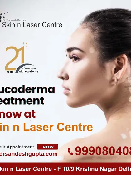 My Skin n Laser Centre in Delhi is a specialty clinic for Leucoderma treatment. I offer advanced and progressive methods for managing white patches on the skin.