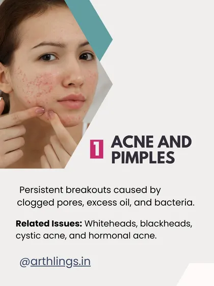 Acne and pimples are persistent breakouts caused by clogged pores, excess oil, and bacteria. Related issues include whiteheads, blackheads, and cystic acne.