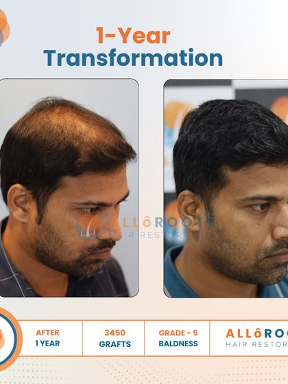 This is a one-year transformation for a Grade 5 baldness case, achieved with 3450 grafts. The before and after photos from various angles show a comprehensive restoration of the scalp, resulting in a full and natural look.