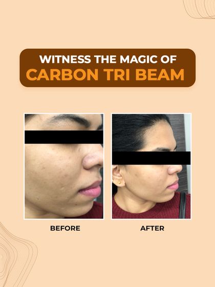 Witness the magic of the Carbon Tri-Beam laser in this before and after. The treatment effectively reduced pigmentation and improved skin texture, resulting in a visibly clearer and more even-toned complexion for our client.