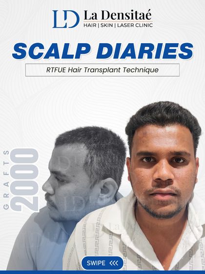 With 2,000 grafts using the RT-FUE technique, I gave Siddhant Gaikwad more than a new hairline; I gave him back his confidence. This is his transformation journey.