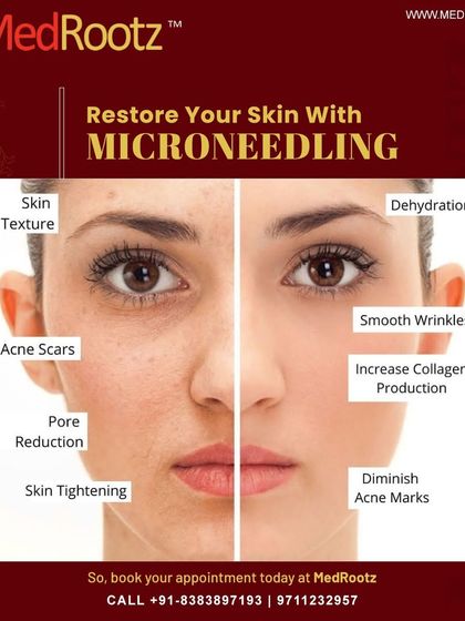 Microneedling is a powerful procedure for overall skin restoration. As this graphic shows, it helps improve skin texture, reduce pore size, diminish acne marks, and stimulate collagen for tighter, smoother skin.