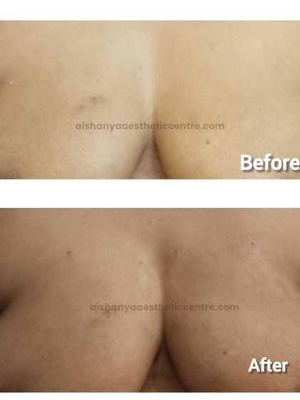 It is possible to enhance cleavage and improve breast shape without surgery. This before-and-after shows the results of a non-surgical breast enhancement technique that provides a natural lift and contour.