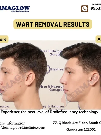 Notice the complete clearance of facial warts in this before-and-after comparison. Our procedure is designed to be effective and gentle, leaving behind smoother skin with minimal signs of the previous blemishes.