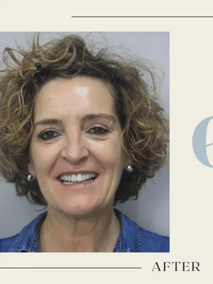 The "after" of a complete smile makeover. Notice the natural luminosity, improved symmetry, and the genuine joy in her expression. This result was achieved through a personalized combination of cosmetic treatments designed to restore both function and beauty.