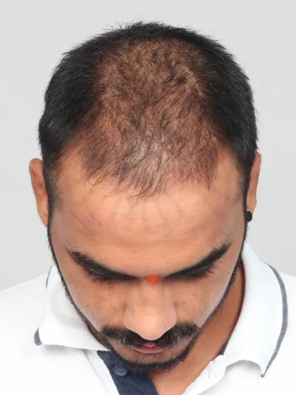 A complete 10-month transformation for a Diffuse Grade 5A case. We recreated the hairline and added density to the frontal and mid-scalp with 3,800 grafts.