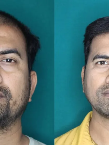 A strong hairline frames the face and restores a youthful appearance. For this patient, I focused on rebuilding his receding hairline and adding density to the frontal region. The result is a natural-looking frame for his face that boosts his confidence.