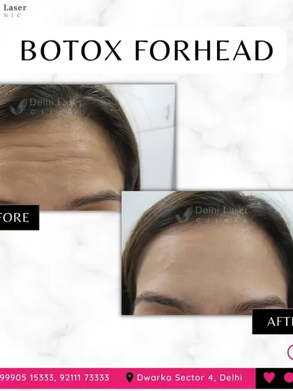 A very common concern I treat is forehead lines and wrinkles. This before and after shows how Botox can effectively smooth these lines, resulting in a relaxed and refreshed appearance. My goal is always to achieve a natural look, not a frozen one.