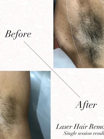 Here are the results after a single session for underarm laser hair removal. This is one of the most common areas I treat, and you can see how quickly we can achieve a noticeable reduction in hair.