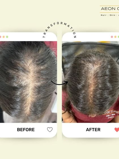 This patient's before and after shows a dramatic improvement in hair density across the top of the scalp, a common area for female pattern hair loss.