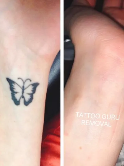 This is another example of a butterfly tattoo, this one a solid black silhouette on the wrist, which has been completely cleared after laser removal sessions.