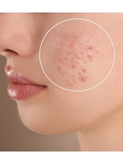 For persistent acne, I focus on healing from the inside out. This condition is often due to excess Pitta and toxins, or 'ama'. My anti-acne treatments involve blood-purifying herbs like Neem and Lodhra, combined with external applications (Lepanam) to reduce inflammation and prevent scarring for clear, healthy skin.