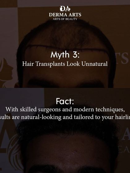 Myth: Hair transplants look unnatural. Fact: A skilled surgeon can create a result that is completely natural. I design hairlines and place grafts in a way that mimics your hair's native growth pattern.