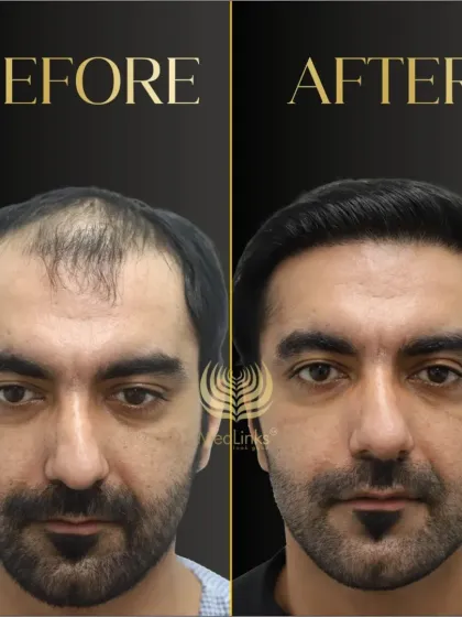 A striking before and after transformation. We addressed both the frontal hair loss and thinning on top, resulting in a look that is years younger and full of confidence.
