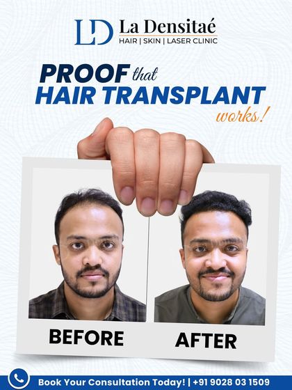 Mr. Vinayak Ahuja used to hide his receding hairline. After his hair transplant with me, he walks with renewed confidence. This before-and-after shot is simple, direct proof of the change that is possible with expert care.