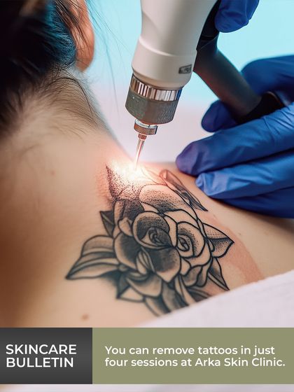 An action shot of a laser tattoo removal session on the neck. The laser is precisely targeted to break down the ink particles without harming the surrounding skin.