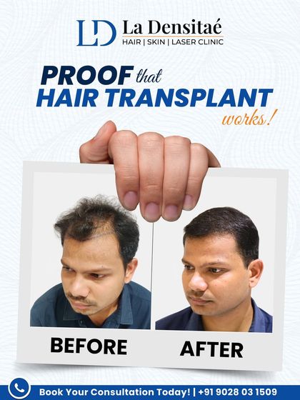 Suryakant walked in hoping for a real solution, not a shortcut. This before-and-after photo shows the result of his trust in my process, a steady and remarkable transformation back to a full head of hair.