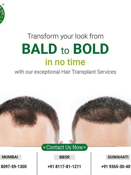 This before and after image shows a transformation from baldness to a bold new look. The FUE hair transplant has restored his hair and his confidence.