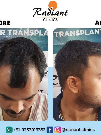 This image shows a classic case of male pattern baldness, with significant recession at the temples. The 'after' photo displays a perfectly reconstructed, dense, and natural-looking hairline.