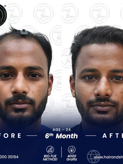 This 24-year-old patient is seeing fantastic results just 6 months after his 4000-graft BIO FUE procedure.