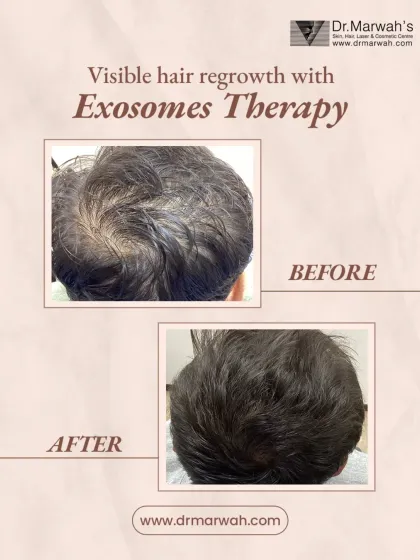 For this male patient, Exosomes Therapy was used to address thinning at the crown. The after image displays a significant increase in volume and coverage, demonstrating the treatment's effectiveness for male pattern hair loss.