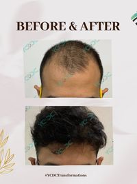 Hair Restoration