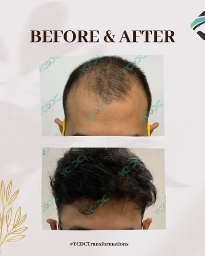 Hair Restoration