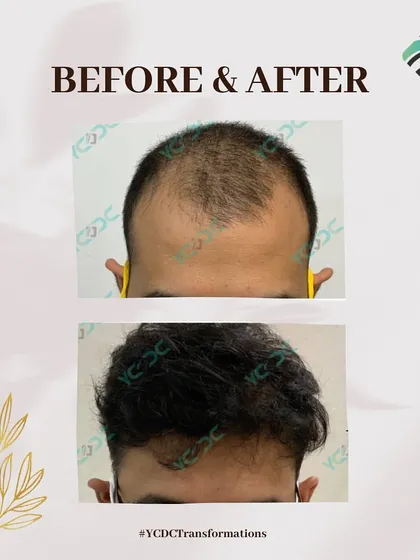 A fantastic before and after result showcasing a significant increase in hair volume and coverage, restoring a youthful and full head of hair.