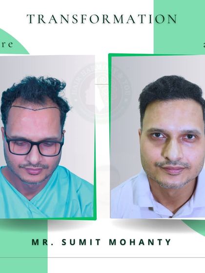 Mr. Sumit Mohanty's transformation is a testament to the power of FUE. The 'after' photo shows a man who looks younger, more confident, and completely revitalized.