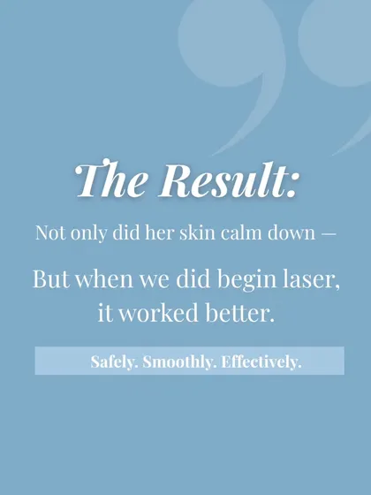 The result of our patient approach. Not only did her skin calm down, but when we finally began the laser treatment, it worked more effectively and safely.