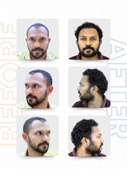Here you can see Mr. Mithun’s transformation from every angle. Notice how the restored hairline and crown coverage blend perfectly, creating a seamless and natural profile. This is the result of meticulous planning and precise execution.