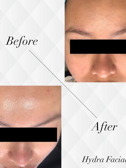 This before and after result showcases the radiant, dewy look achieved with a HydraFacial, perfect for getting that festive glow.